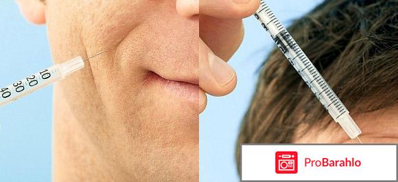 Диспорт фото до и после фото