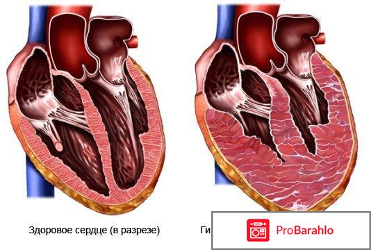 Увеличение сердца: причины, симптомы, лечение отрицательные отзывы