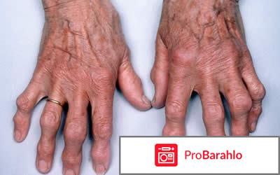 Артромед Ультра обман