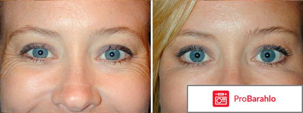 Рефайнекс отзывы отрицательные отзывы