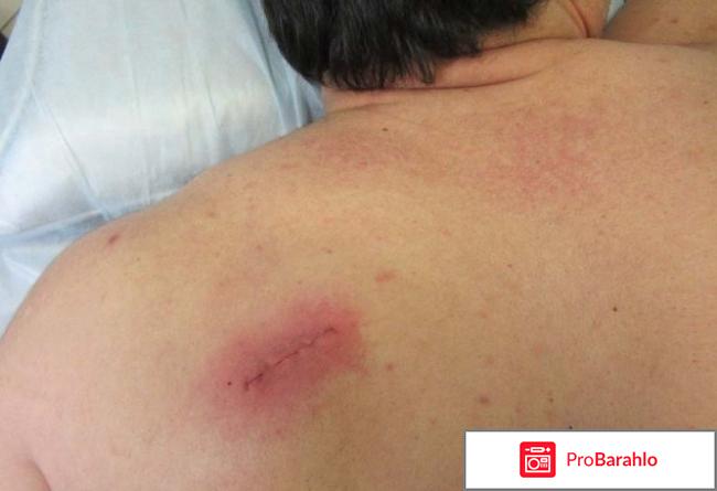 Удаление липомы отзывы отрицательные отзывы