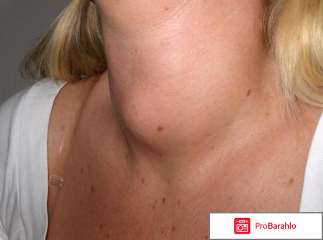 Щитовидная железа лечение отрицательные отзывы