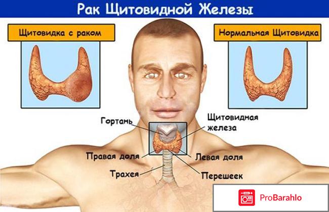 Щитовидная железа: симптомы заболевания у мужчин отрицательные отзывы