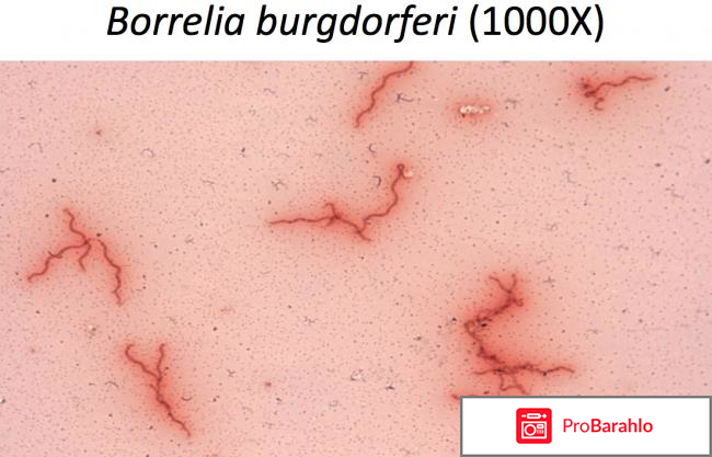Результаты анализа на боррелиоз норма отрицательные отзывы