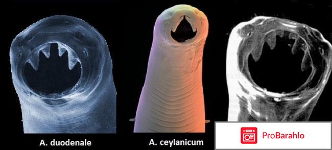 Анкилостома у человека симптомы лечение 