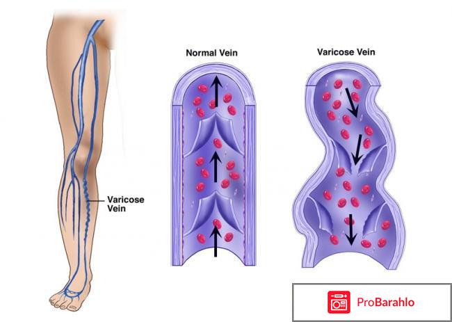 Варикоз фото 