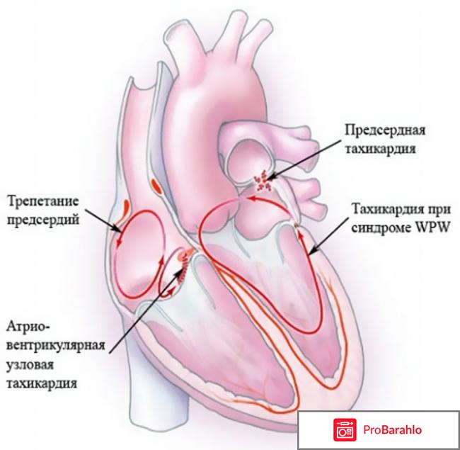 Тахикардия 