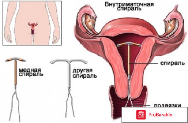 Спираль внутриматочная специалистов 