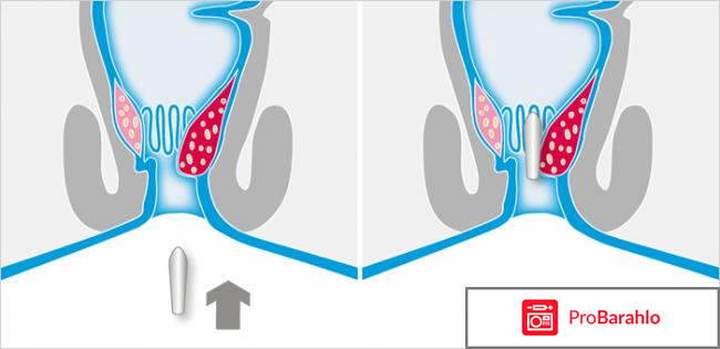 Проктозан свечи цена обман