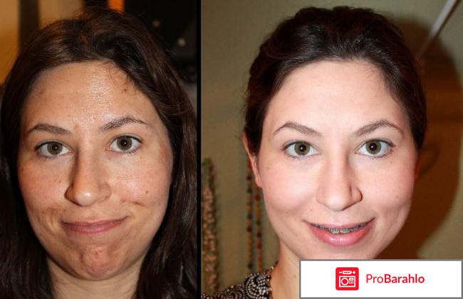 Срединный пилинг обман