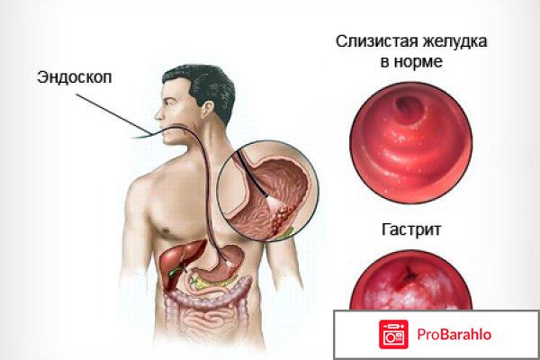 Pyloras (Пилорас) от гастрита и язвы 