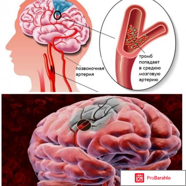 Зилт инструкция по применению цена отзывы отрицательные отзывы