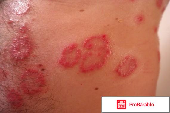 Quannaide Xinmeisu Tiegao – пластыри от псориаза отрицательные отзывы