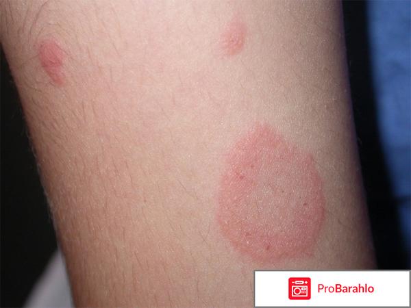 Эплан мазь инструкция по применению цена отзывы отрицательные отзывы