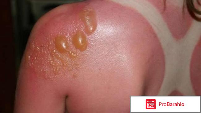 Солкосерил, мазь 