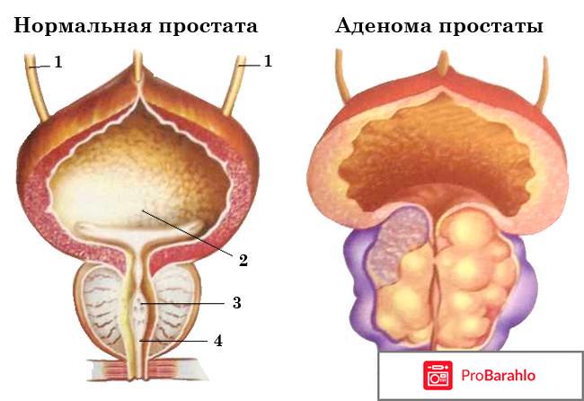 Аденома простаты у мужчин симптомы лечение отзывы отрицательные отзывы