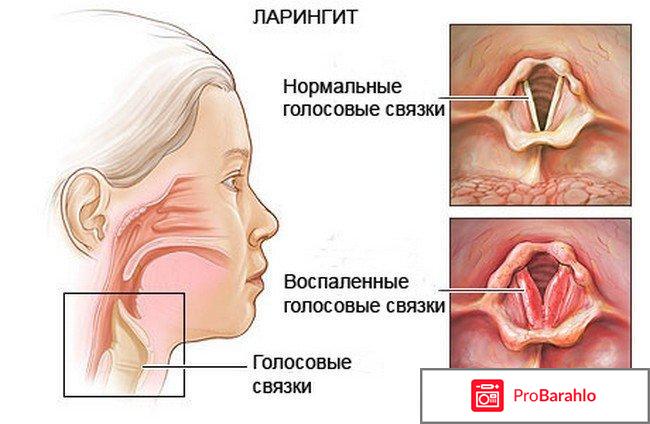 Ларингит симптомы отрицательные отзывы