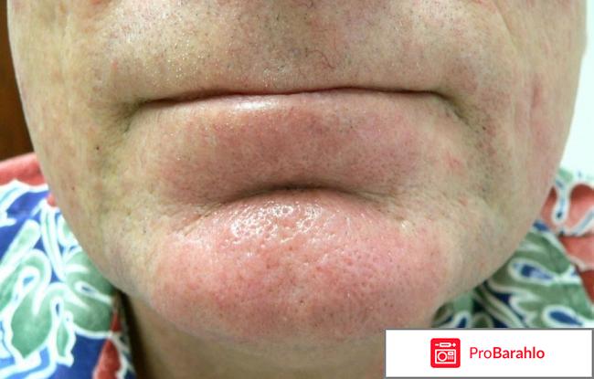 Сосуды на лице