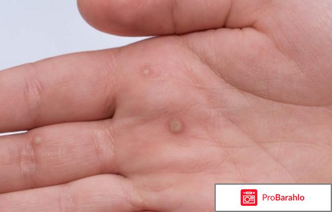 Лечение впч у женщин препараты отзывы обман