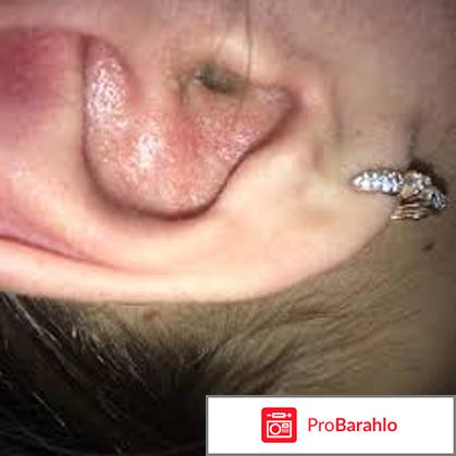 Шелушатся ушные раковины — Причины и лечение отрицательные отзывы