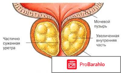Средство против простатита отрицательные отзывы