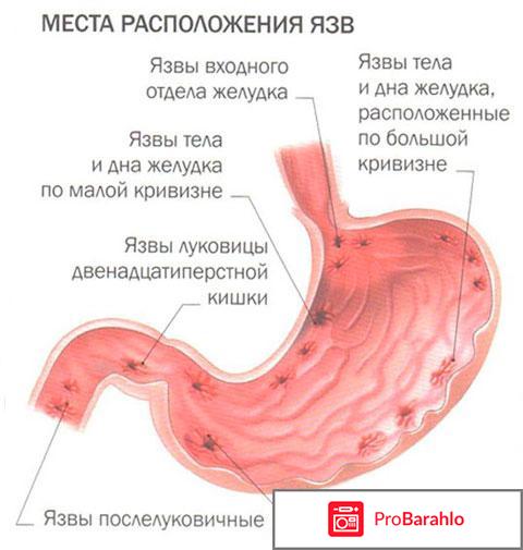 Схема лечения язвы 12 перстной кишки препараты отрицательные отзывы