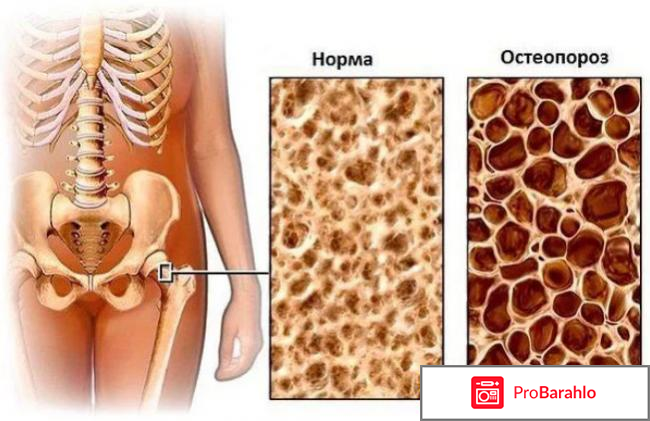 Акласта отзывы пациентов побочные явления форум 