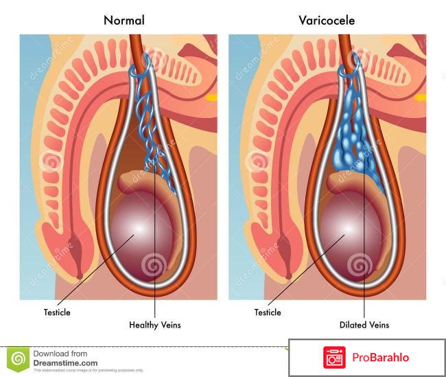 Варикоцеле операция 
