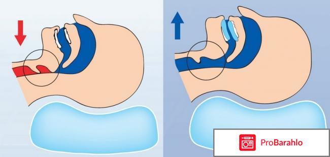 Лечение храпа 