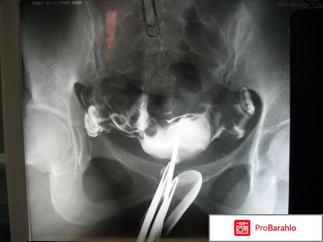 Спаечный процесс в малом тазу отрицательные отзывы