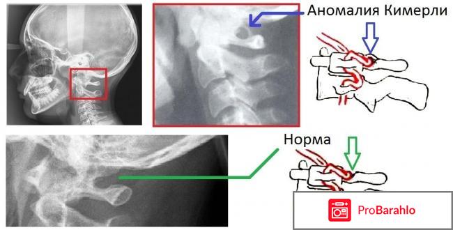 Аномалия киммерли как лечить 