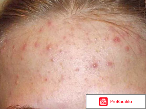 Метилурацил мазь цена отзывы обман