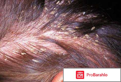 Шампунь от псориаза отзывы 