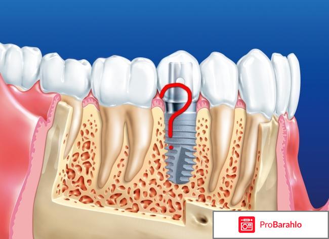 Имплантация зубов отзывы пациентов форум 2018 обман