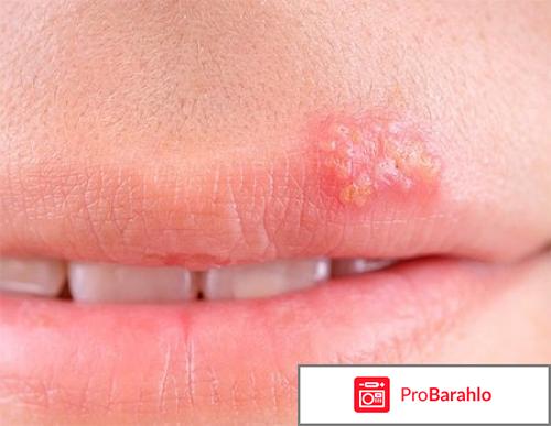 АЛЛОКИН-АЛЬФА лиофилизат 