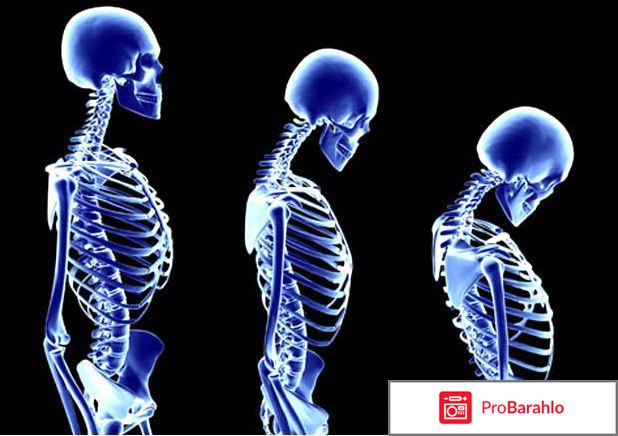 Профилактика остеопороза отрицательные отзывы