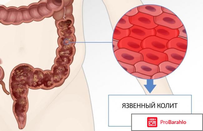 Чем опасен язвенный колит кишечника 