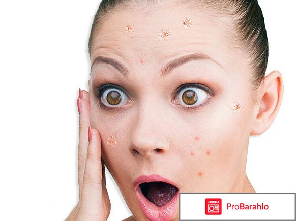 Циновит крем от прыщей 