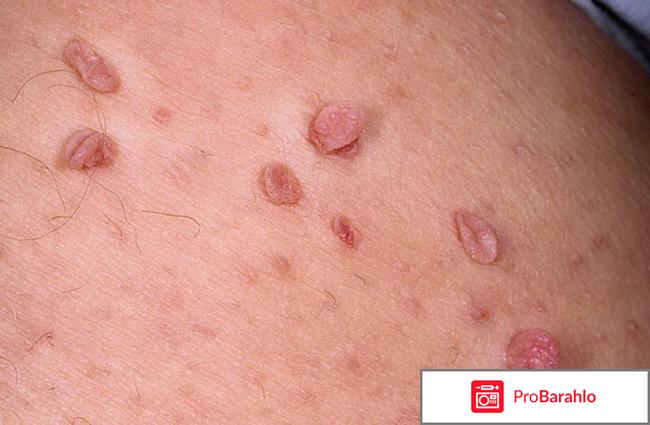 Папиллом отзывы врачей отрицательные отзывы