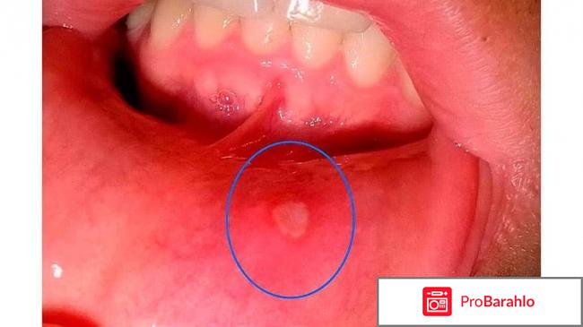 Язва во рту: Лечение в домашних условиях обман