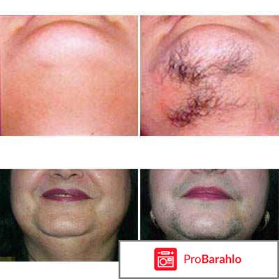 Риванол для удаления волос отзывы цена отзывы владельцев