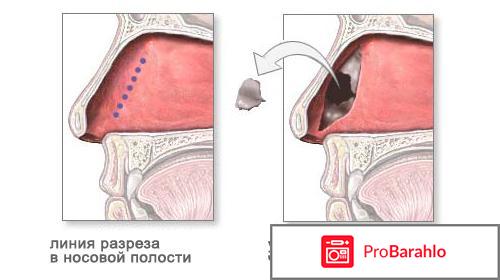 Операция на перегородку носа 