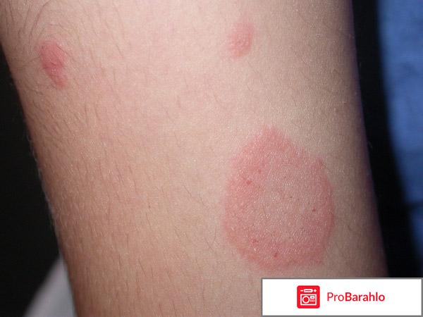 Пятна на теле обман