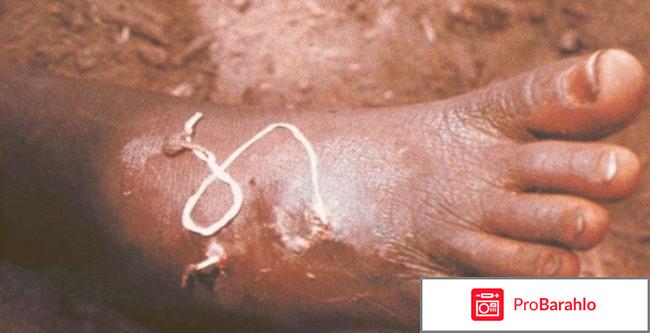 Подкожный червь 