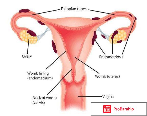 Бусерелин депо отзывы 