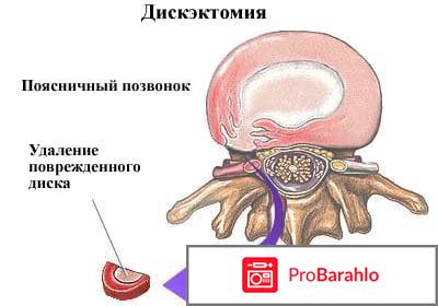 Дискэктомия что это такое отрицательные отзывы