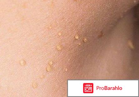 Как избавиться от папиллом под мышками отрицательные отзывы