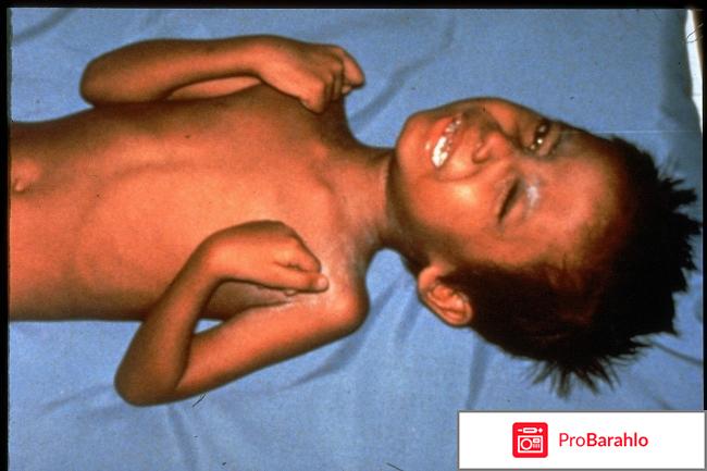 Прививку от столбняка отрицательные отзывы