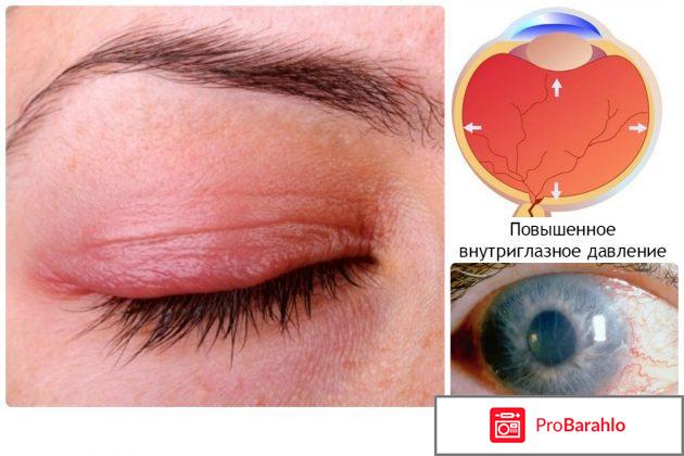 Ксонеф глазные капли инструкция цена отзывы отрицательные отзывы