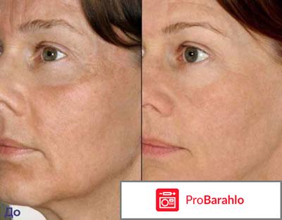 Мезороллер фото до и после отрицательные отзывы